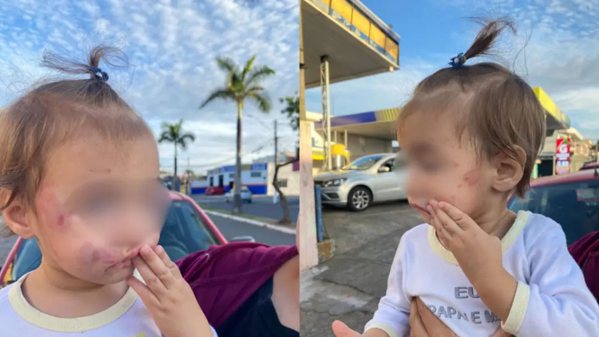 Bebê de apenas um ano e dois meses que voltou para casa com diversas mordidas no rosto após passar o dia em uma creche conveniada ao PROEB (Programa de Educação