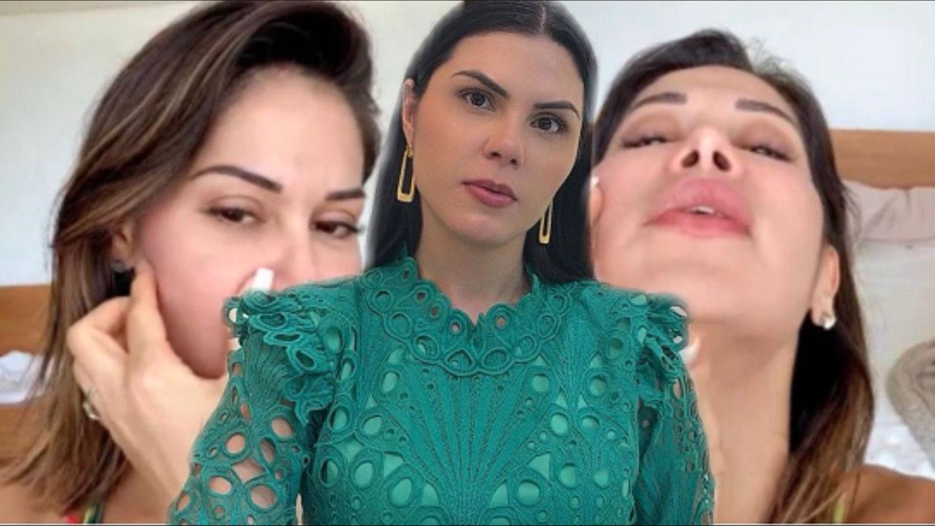 Alerta na Estética: Os Riscos do Uso de PMMA Destacados pela Cirurgia de Maira Cardi