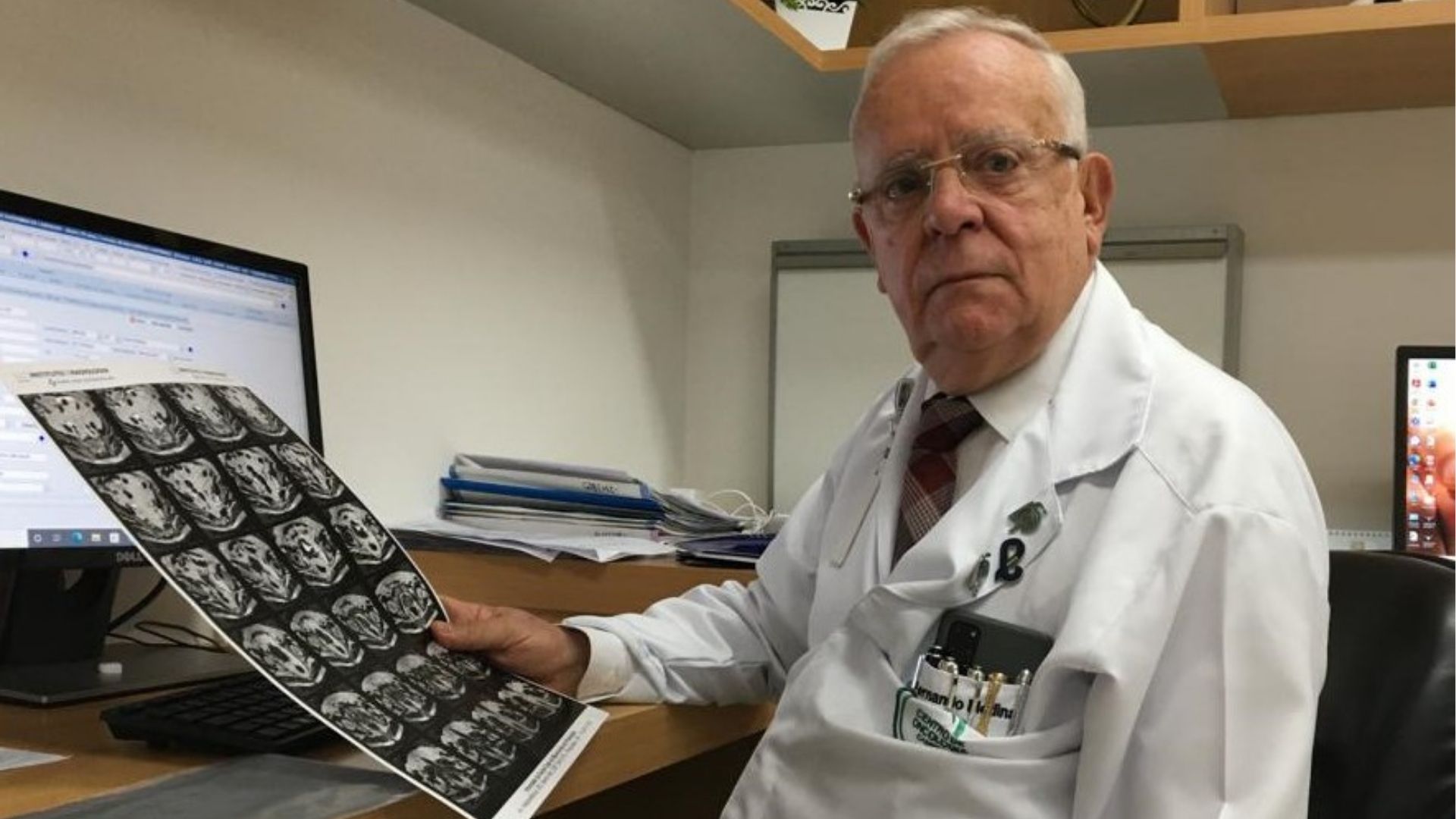 Síndrome de Lynch aumenta risco de câncer colorretal no Brasil