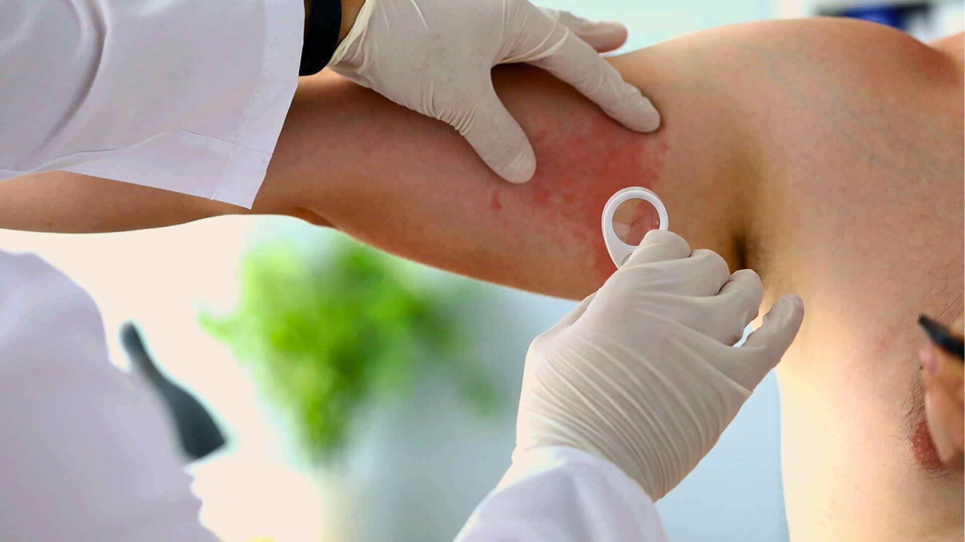 Hanseníase: entenda doença que afeta nervos e pele