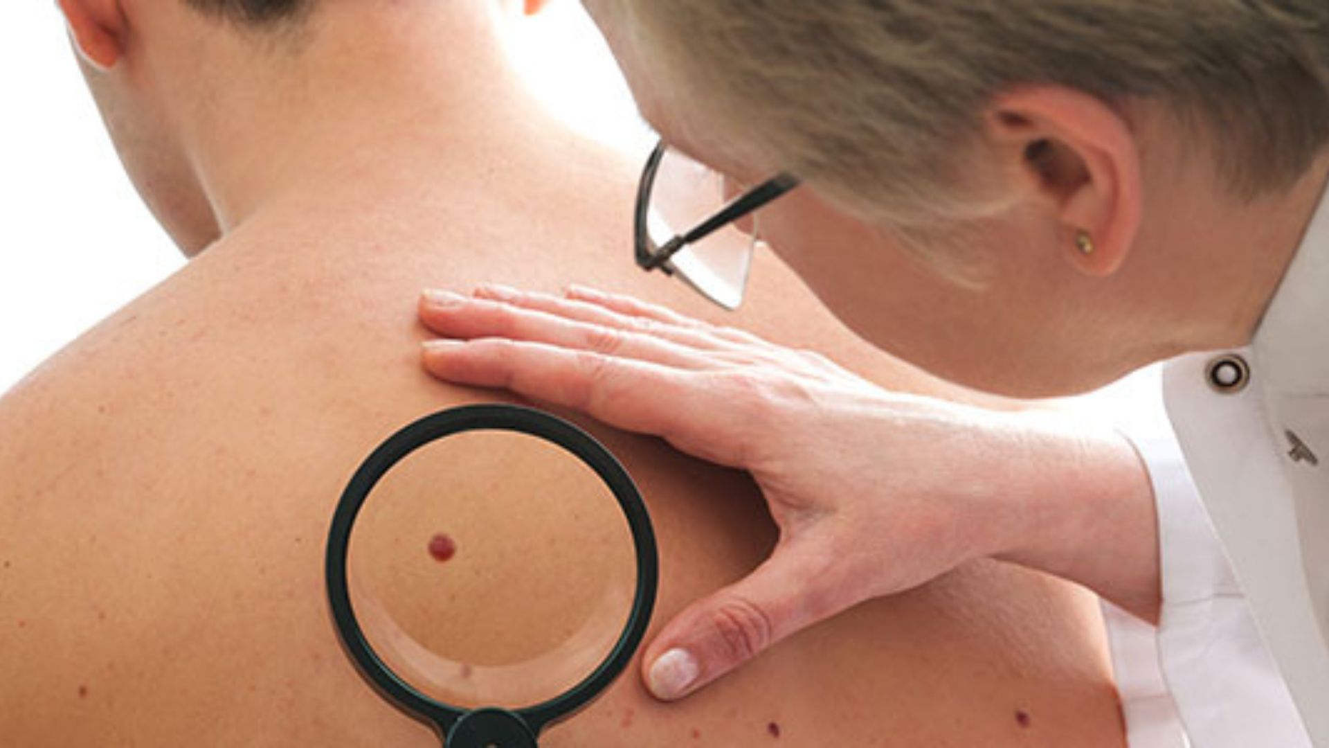 Câncer de pele: entenda tipos, sinais e como prevenir com proteção diária