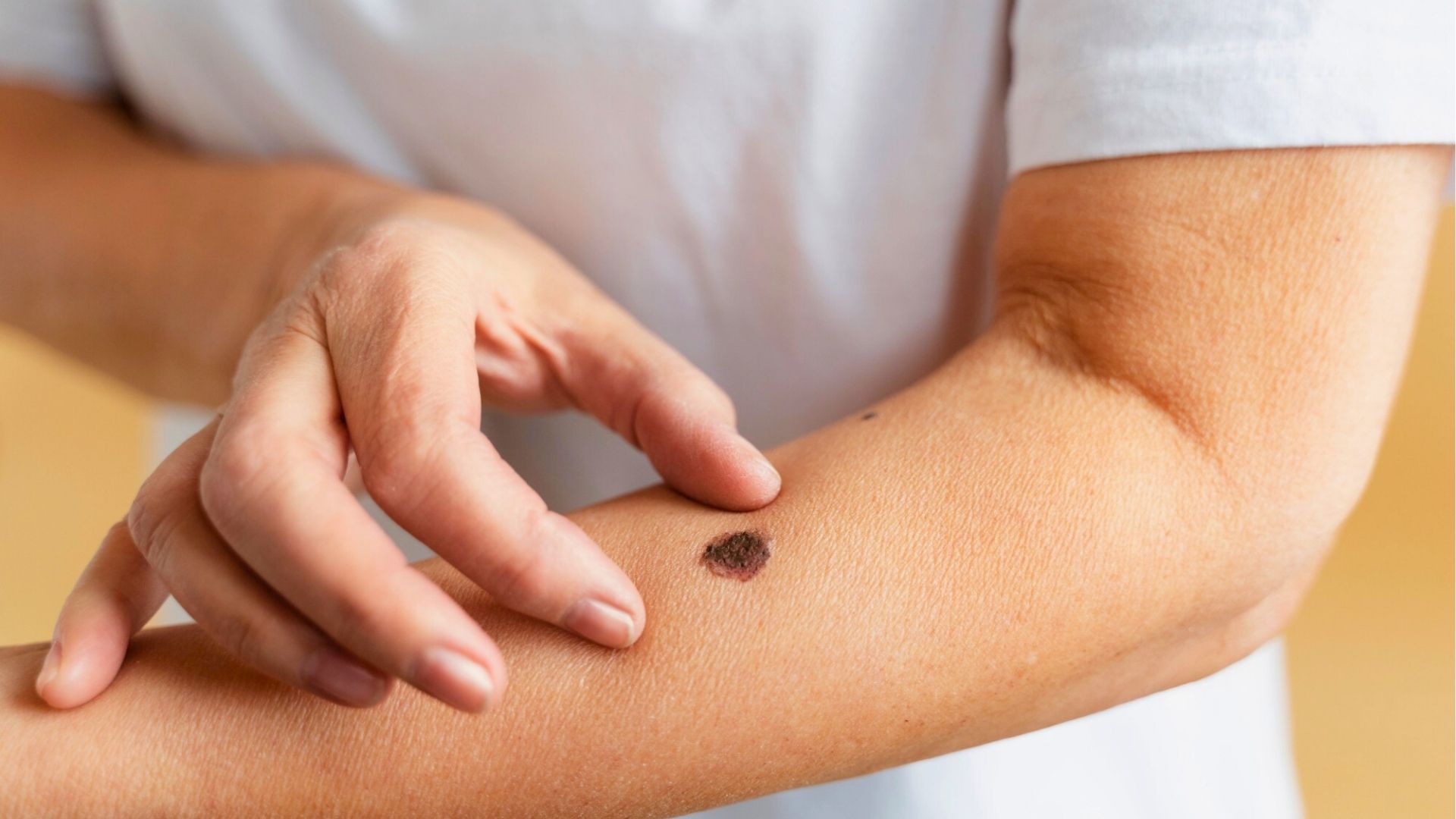 Bronzeamento em câmaras UV aumenta 75% risco de melanoma